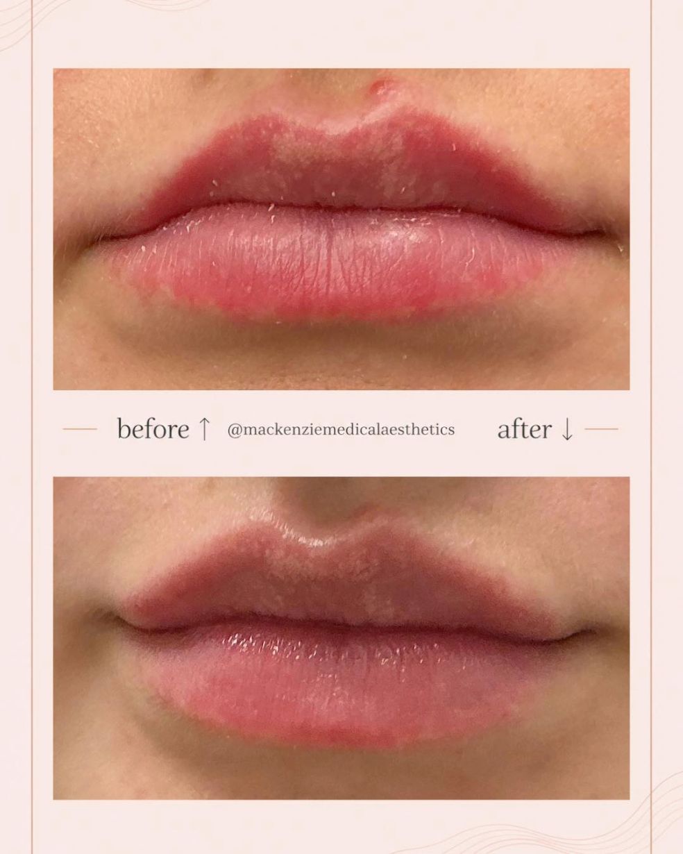 Original before-and-after lip enhancement photographs from Mackenzie Medical Aesthetics